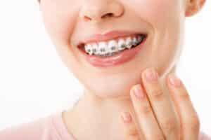 Close up of woman’s smile with traditional braces on the outside of the teeth in Denver