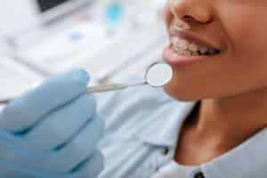 A close-up shot of braces on a woman's teeth