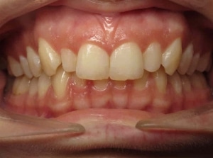 1766076507_anna-bozek-b-1 1766076507 anna bozek b 1 1 Invisalign in Denver, CO