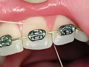 braces-2 braces 2 Braces in Denver, CO