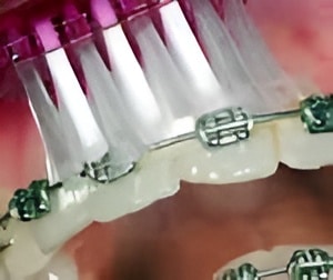 braces braces Braces in Denver, CO