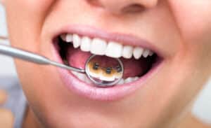A close-up shot of lingual braces on a woman’s teeth