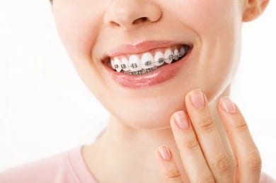 smile-braces-orthodontic-treatment-dental-260nw-2123111183 A close-up shot of a woman with braces after an orthodontic emergency in Denver