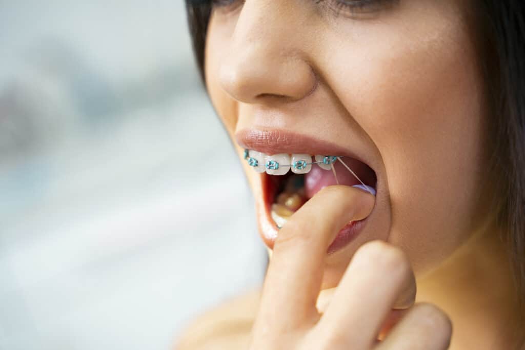 Patient placing an orthodontic rubber band on braces